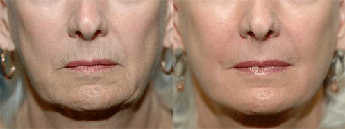 terapia con láser antes y después