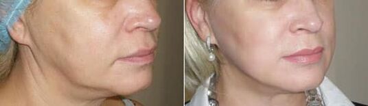 Foto después de aplicar el procedimiento