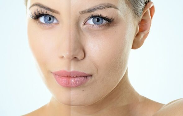 Indicaciones para el rejuvenecimiento fraccional