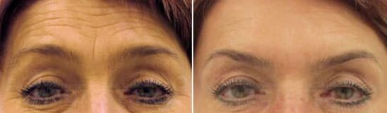 Rejuvenecimiento de campo de la frente