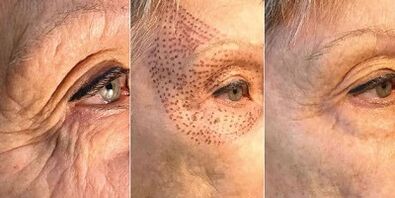 Fotos antes y después del rejuvenecimiento de la piel con plasma.